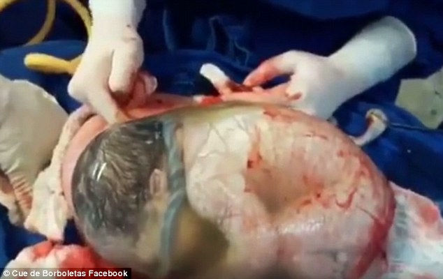 spanish baby still born in amniotic sac