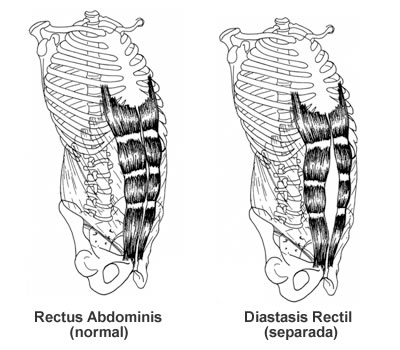 Muscle Separation Post Pregnancy - Lose Baby Weight